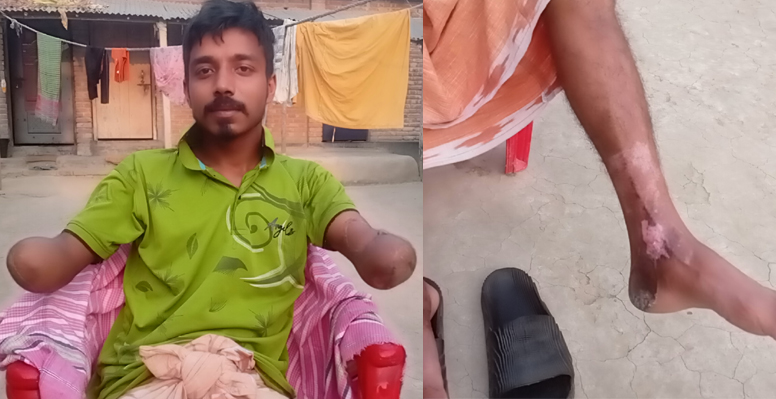 ভুল তথ্যে বৈদ্যুতিক শকে দুই হাত হারিয়ে পঙ্গু মিরপুরের সাঈদ, প্রতারণার অভিযোগ 