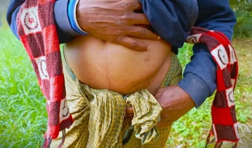 বাংলাদেশে ‘এক কিডনির গ্রাম’, ফাঁদে পড়ে নিঃস্ব দরিদ্র মানুষ 4 বাংলাদেশে ‘এক কিডনির গ্রাম ফাঁদে পড়ে নিঃস্ব দরিদ্র মানুষ 1751642564 বাংলাদেশে ‘এক কিডনির গ্রাম’, ফাঁদে পড়ে নিঃস্ব দরিদ্র মানুষ