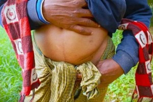 বাংলাদেশে ‘এক কিডনির গ্রাম’, ফাঁদে পড়ে নিঃস্ব দরিদ্র মানুষ