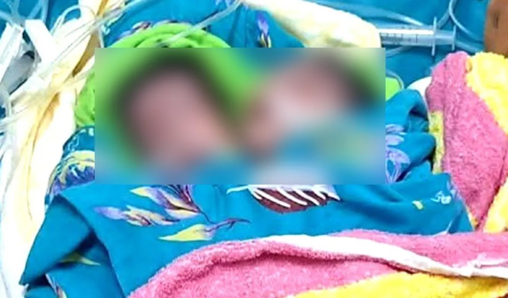 রাজশাহীতে দুই মাথা নিয়ে শিশুর জন্ম 4 রাজশাহী