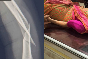 আকাশে ঝাঁকুনির কবলে বিমান বাংলাদেশ, হাত ভাঙল কেবিন ক্রুর