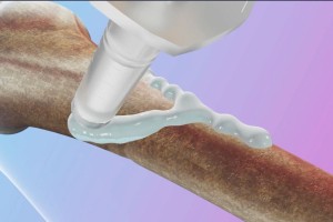 আঠা দিয়ে মাত্র ৩ মিনিটেই জোড়া লাগবে হাড়