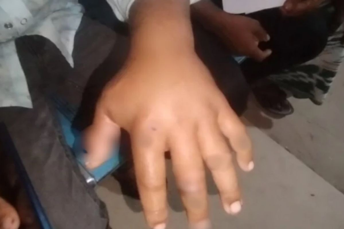 অসুস্থ গরু জবাই, ১১ জনের শরীরে অ্যানথ্রাক্সের লক্ষণ