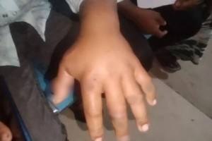 অসুস্থ গরু জবাই, ১১ জনের শরীরে অ্যানথ্রাক্সের লক্ষণ