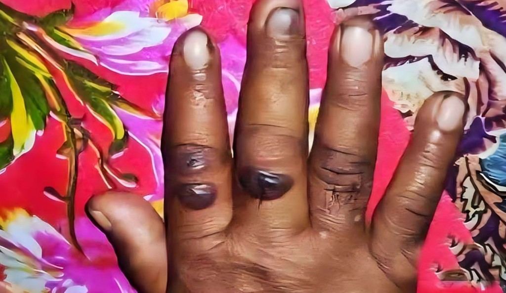 অ্যানথ্রাক্স রোগের উপসর্গ নিয়ে নারীর মৃত্যু 4 অ্যানথ্রাক্স রোগের উপসর্গ নিয়ে নারীর মৃত্যু 1759718969 অ্যানথ্রাক্স রোগের উপসর্গ নিয়ে নারীর মৃত্যু