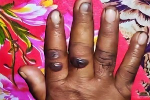 অ্যানথ্রাক্স রোগের উপসর্গ নিয়ে নারীর মৃত্যু