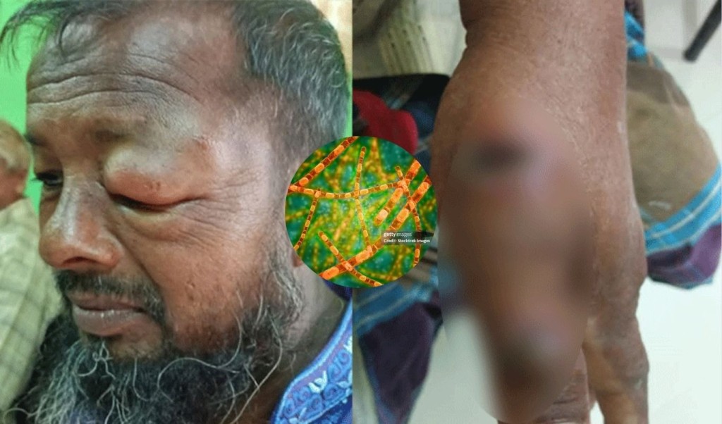 অ্যানথ্রাক্সের উপসর্গ ১১ জনের শরীরে, আক্রান্ত হলো যেভাবে 4 অ্যানথ্রাক্সের উপসর্গ ১১ জনের শরীরে ছড়াচ্ছে যেভাবে 1759495593 অ্যানথ্রাক্সের উপসর্গ ১১ জনের শরীরে, আক্রান্ত হলো যেভাবে