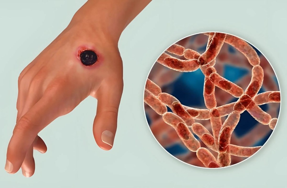 আরও তিনজনের শরীরে অ্যানথ্রাক্স শনাক্ত