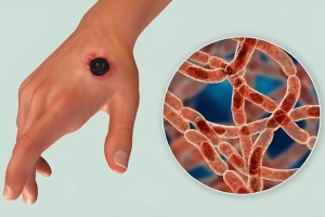 আরও তিনজনের শরীরে অ্যানথ্রাক্স শনাক্ত