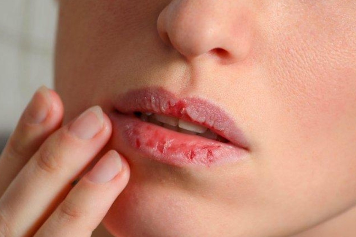 শীত আসার আগেই ঠোঁট ফাটছে? জানুন করণীয়