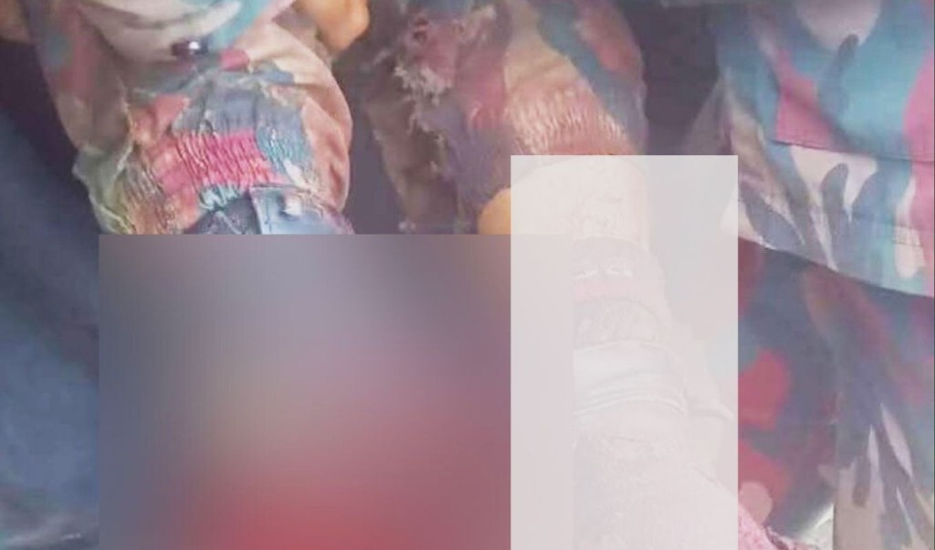 স্থলমাইন বিস্ফোরণে উড়ে গেল বিজিবি সদস্যের পা 3 স্থলমাইন বিস্ফোরণে উড়ে গেল বিজিবি সদস্যের পা 1760272238 স্থলমাইন বিস্ফোরণে উড়ে গেল বিজিবি সদস্যের পা