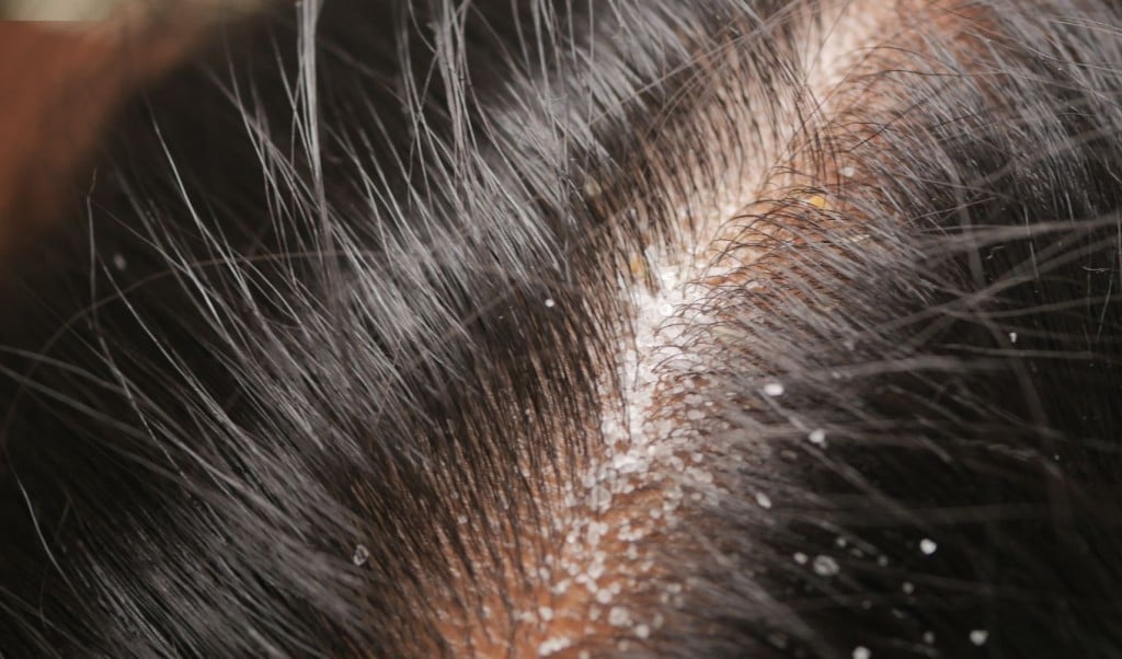 Daily Habits Responsible for Dandruff and Hair Fall 1763100186 খুশকি ও চুল পড়ার পিছনে দায়ী দৈনন্দিন অভ্যাসগুলো