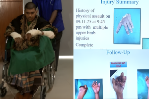 ২০ ঘণ্টা পর কুড়িয়ে আনা হাত জোড়া লাগিয়ে ইতিহাস জাতীয় বার্ন ইনস্টিটিউটের