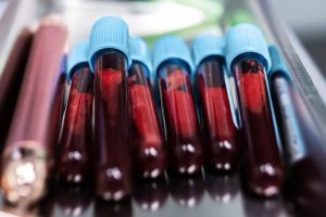 স্তন ক্যানসারে নতুন গেম-চেঞ্জার পরীক্ষা