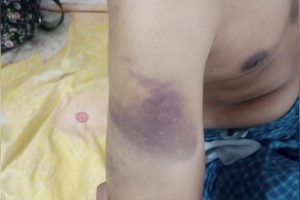 গাইবান্ধায় নিরাময়কেন্দ্রে যুবককে অমানবিক নির্যাতন, থানায় অভিযোগ