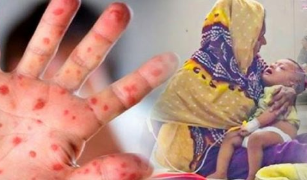 কুমিল্লায় হামের উপসর্গে শিশুমৃত্যু নতুন রোগী ৫০ জন শনাক্ত কুমিল্লায় হামের উপসর্গে শিশুমৃত্যু, নতুন রোগী ৫০ জন শনাক্ত