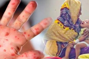 কুমিল্লায় হামের উপসর্গে শিশুমৃত্যু, নতুন রোগী ৫০ জন শনাক্ত