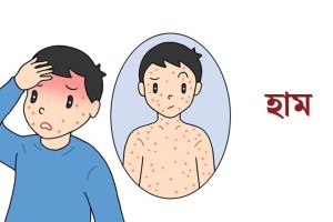 চট্টগ্রামে তিন লাখ শিশুকে হাম-রুবেলা টিকা প্রদানের বিশেষ কর্মসূচি