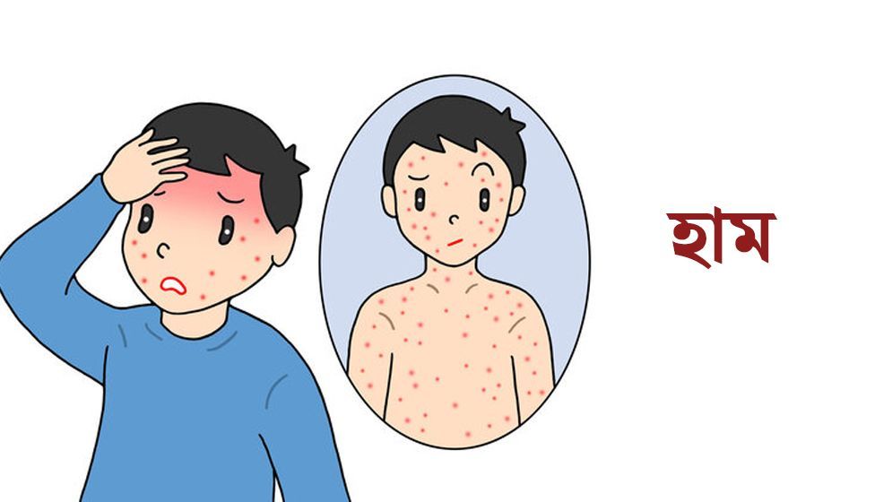 চট্টগ্রামে তিন লাখ শিশুকে হাম রুবেলা টিকা প্রদানের বিশেষ কর্মসূচি চট্টগ্রামে তিন লাখ শিশুকে হাম-রুবেলা টিকা প্রদানের বিশেষ কর্মসূচি