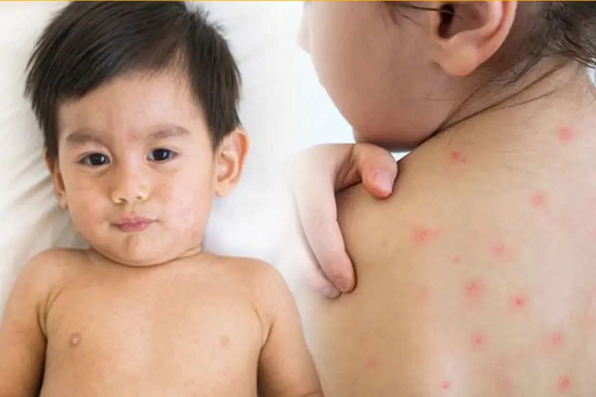 হাম টিকাদান কার্যক্রমে নতুন জরুরি ধাপ শুরু শনিবার