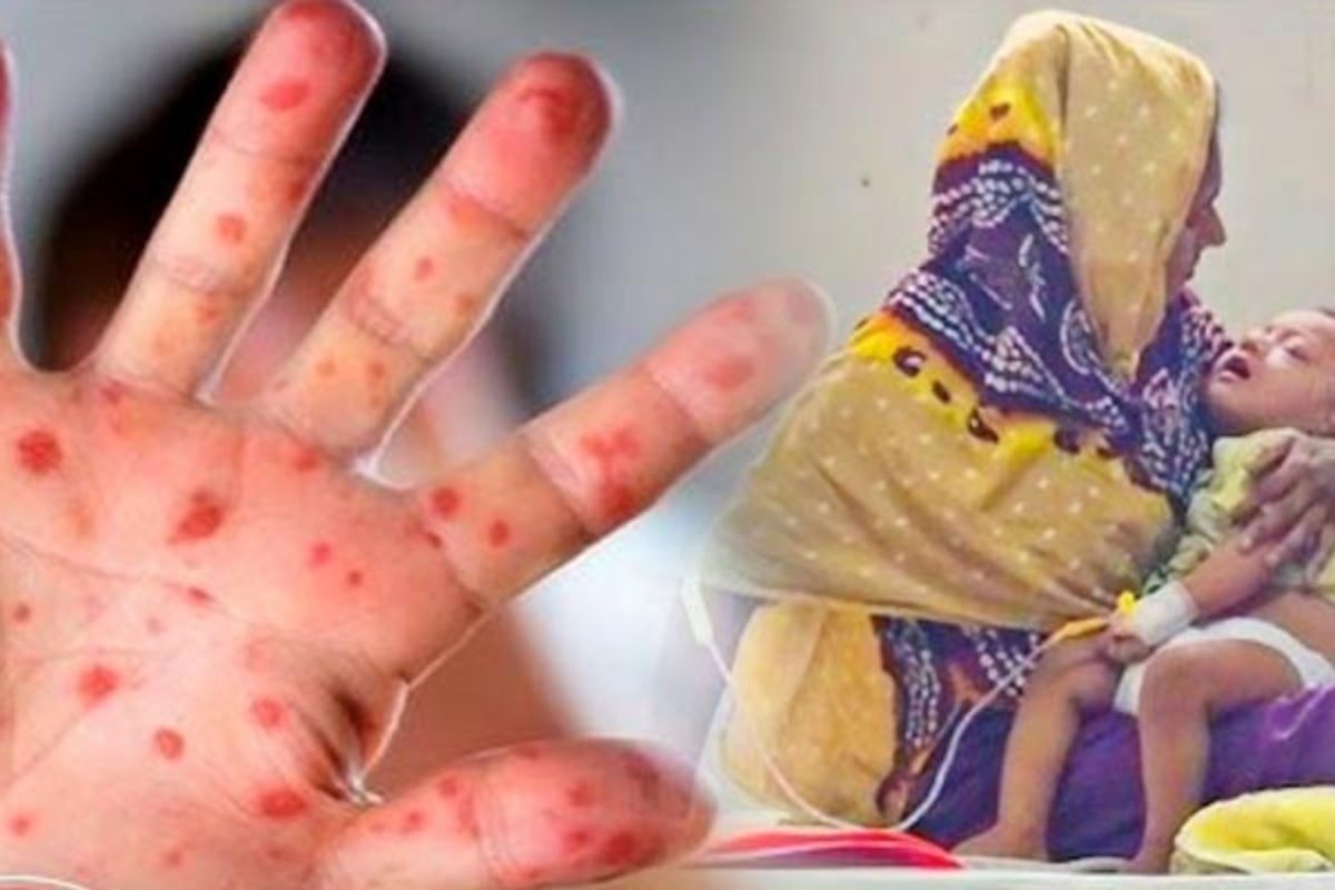 ২৪ ঘণ্টায় হাম ও উপসর্গে শিশুদের মৃত্যু