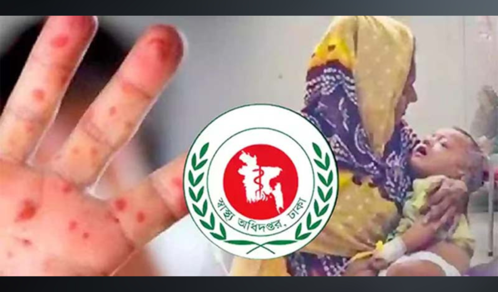 হাম ও উপসর্গে দেশে ৮৯ দিনে ৬৪৩ শিশুর মৃত্যু হাম ও উপসর্গে দেশে ৮৯ দিনে ৬৪৩ শিশুর মৃত্যু