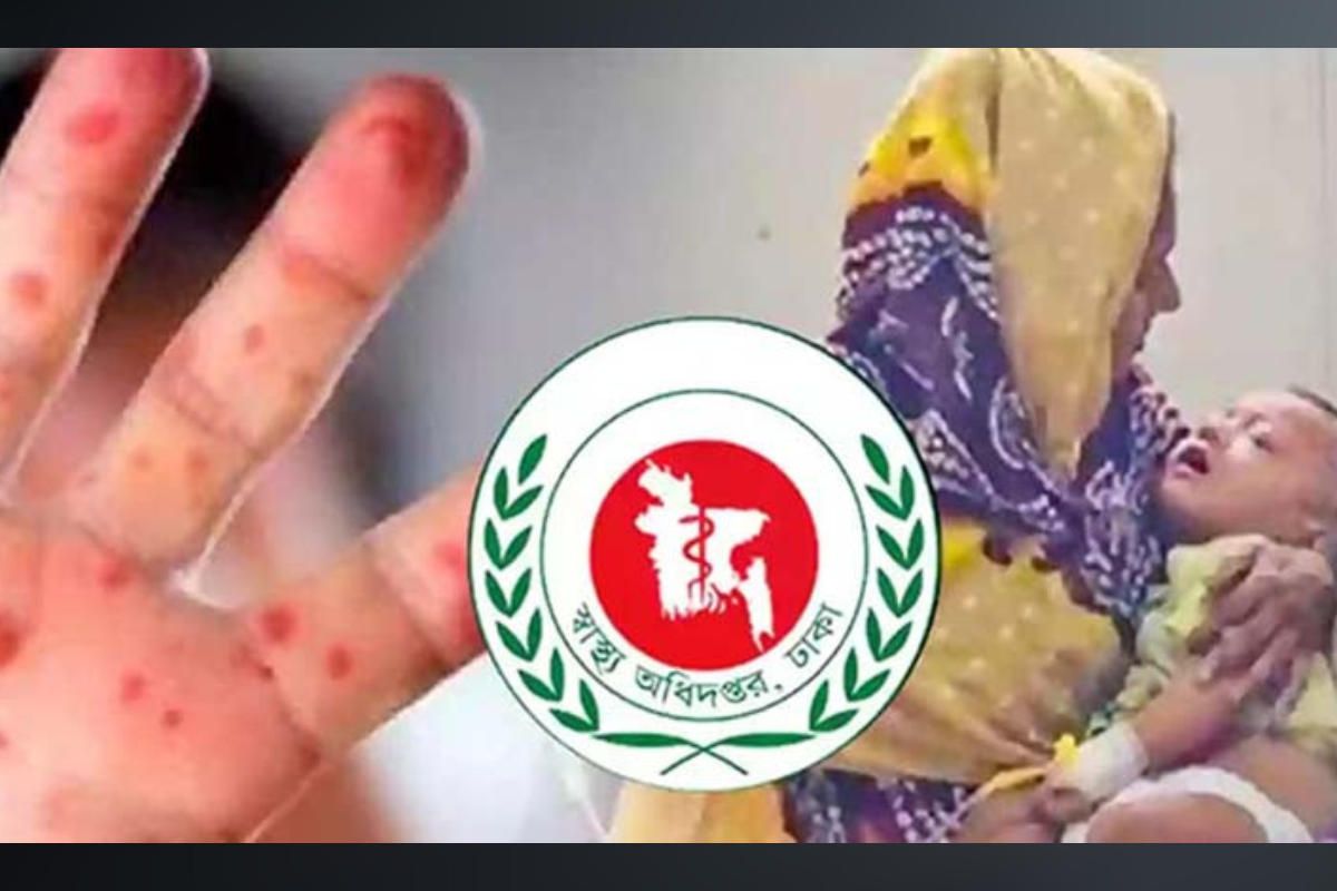 হাম ও উপসর্গে দেশে ৮৯ দিনে ৬৪৩ শিশুর মৃত্যু