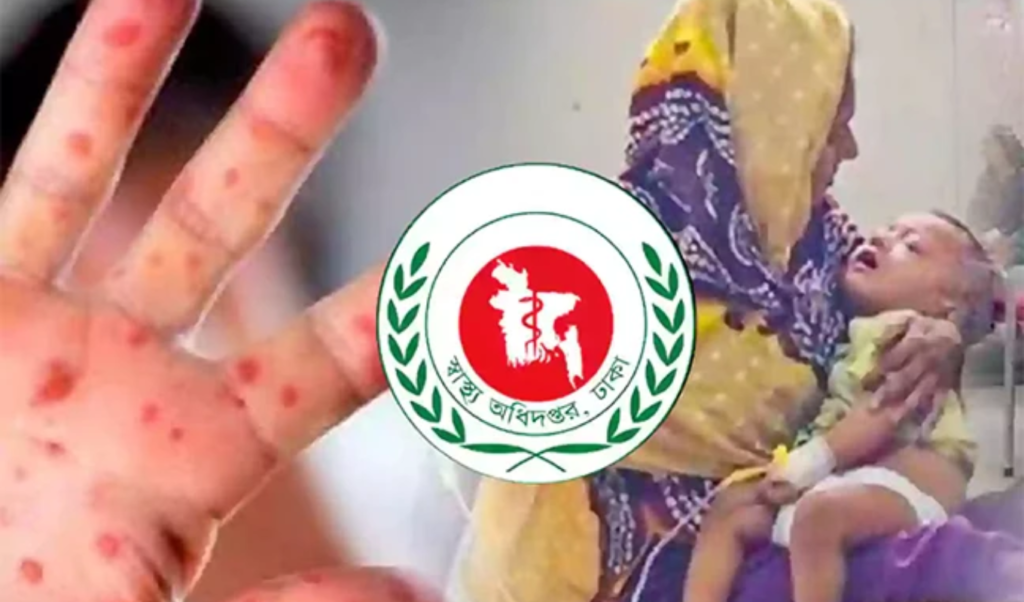 দেশে ২৪ ঘণ্টায় হামের উপসর্গে আরও ৫ শিশুর মৃত্যু দেশে ২৪ ঘণ্টায় হামের উপসর্গে আরও ৫ শিশুর মৃত্যু