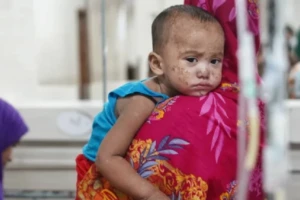 সারাদেশে হামের বিস্তার, সন্দেহভাজন আরও তিনজনের মৃত্যু