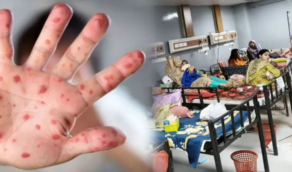 হাম ও উপসর্গে দেশে মৃত্যু বেড়ে ৭৪৫ ২৪ ঘণ্টায় প্রাণ হারালেন ৩ জন হামে আরও ৩ শিশুর মৃত্যু: মোট প্রাণহানি ৭৫৩, আক্রান্ত ৯৩ হাজার ছাড়াল