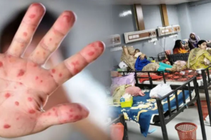 হাম ও উপসর্গে দেশে মৃত্যু বেড়ে ৭৪৫, ২৪ ঘণ্টায় প্রাণ হারালেন ৩ জন