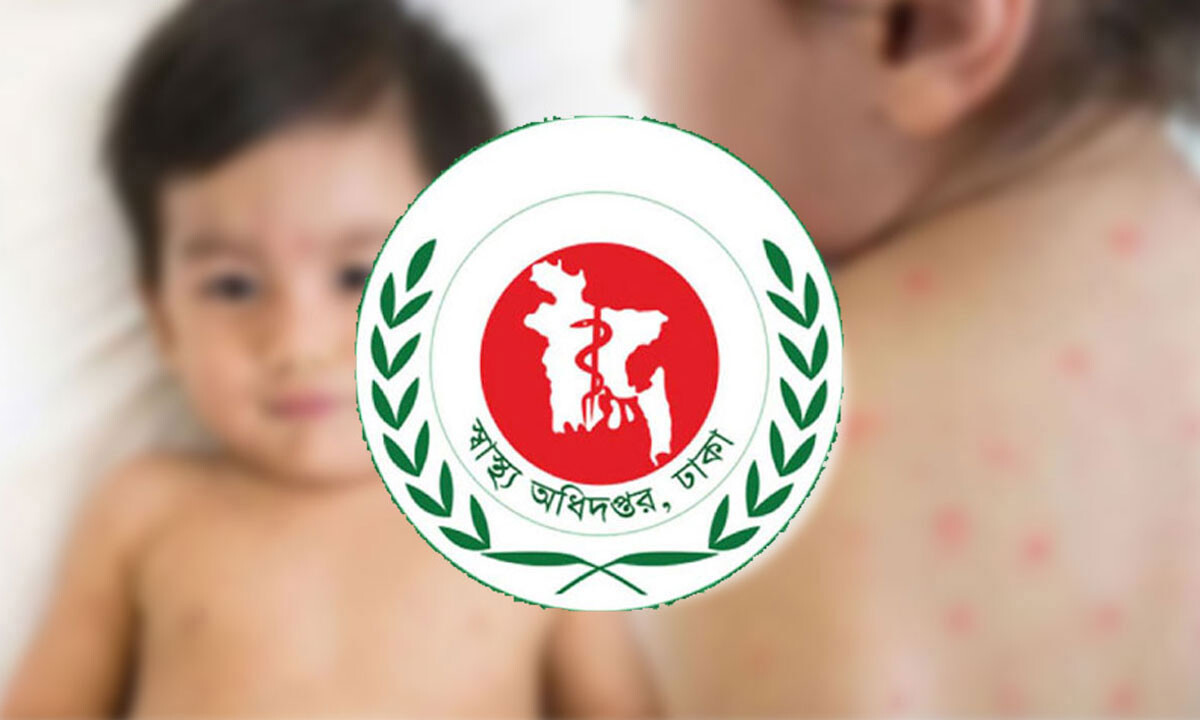 হামে মৃত্যু বেড়ে ৭৯৩, হাসপাতালে আরও ১,০৬৯ শিশু