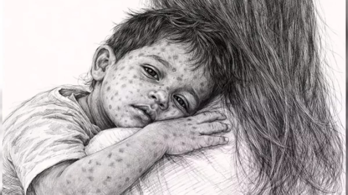 হামের উপসর্গে আরও ৪ মৃত্যু, মোট প্রাণহানি ৮২০