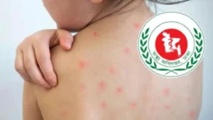 হামের উপসর্গে ২৪ ঘণ্টায় আরও ছয়জনের মৃত্যু
