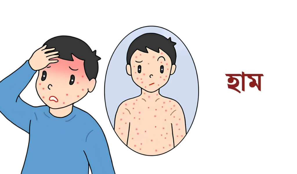 সিলেটে হামে আরও দুই শিশুর মৃত্যু, বিভাগে মোট প্রাণহানি ২০২ 3 সিলেটে হামে আরও দুই শিশুর মৃত্যু, বিভাগে মোট প্রাণহানি ২০২