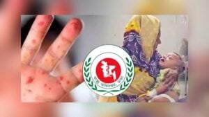 হামের উপসর্গে আরও ৮ শিশুর মৃত্যু, আক্রান্ত ১ হাজার ৮৬